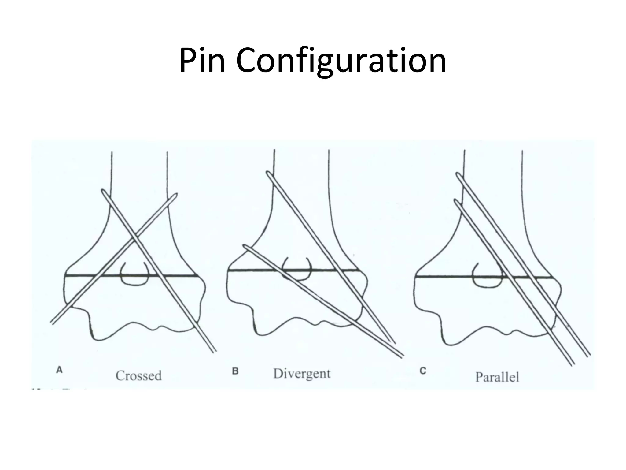 Condyle Pin Elbow Classificaton-of-injuries-around-elbow-management-of-supracondylar ...