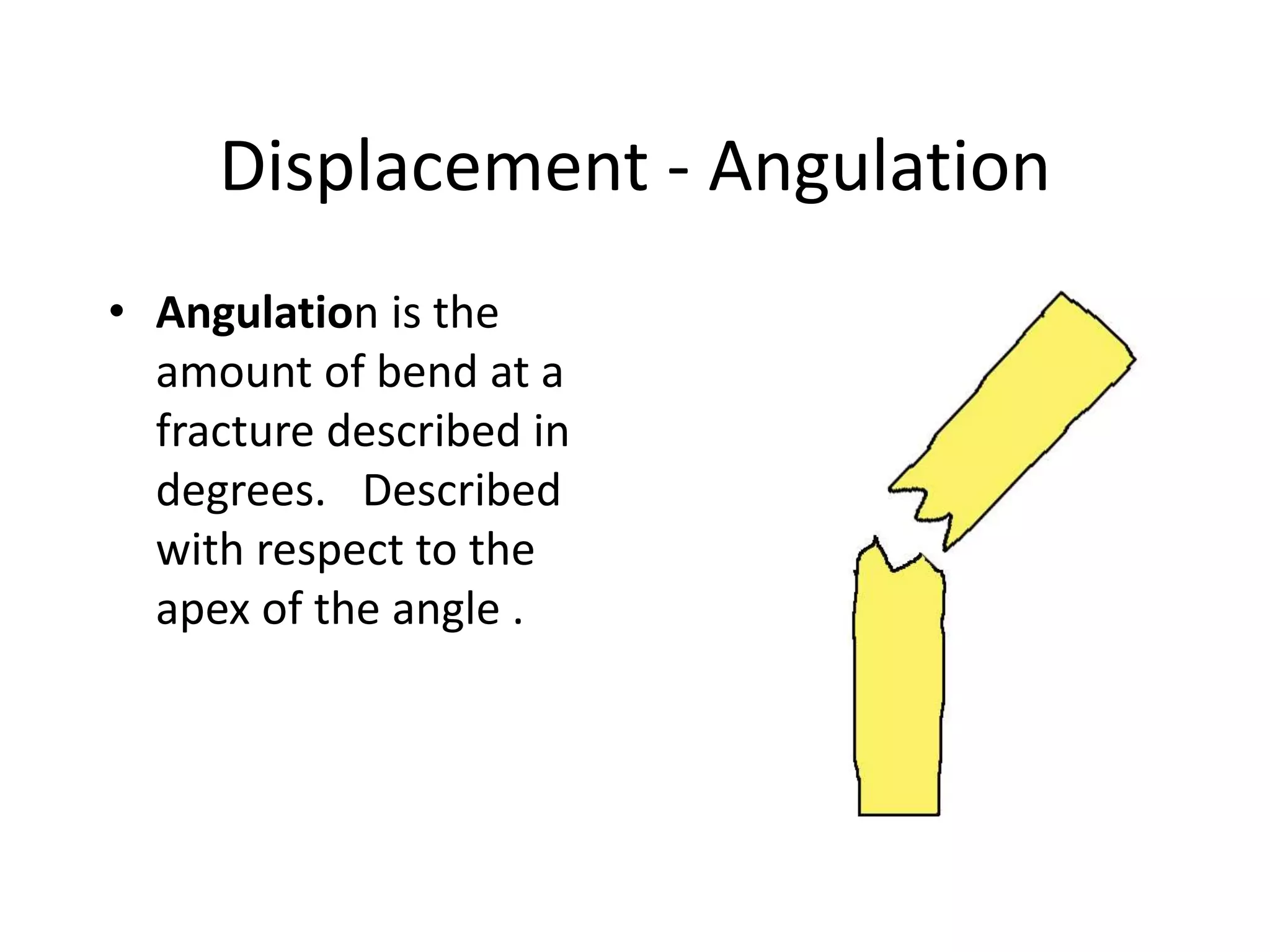 Displacement - Angulation 
• Angulation is the 
amount of bend at a 
fracture described in 
degrees. Described 
with respect to the 
apex of the angle . 
 