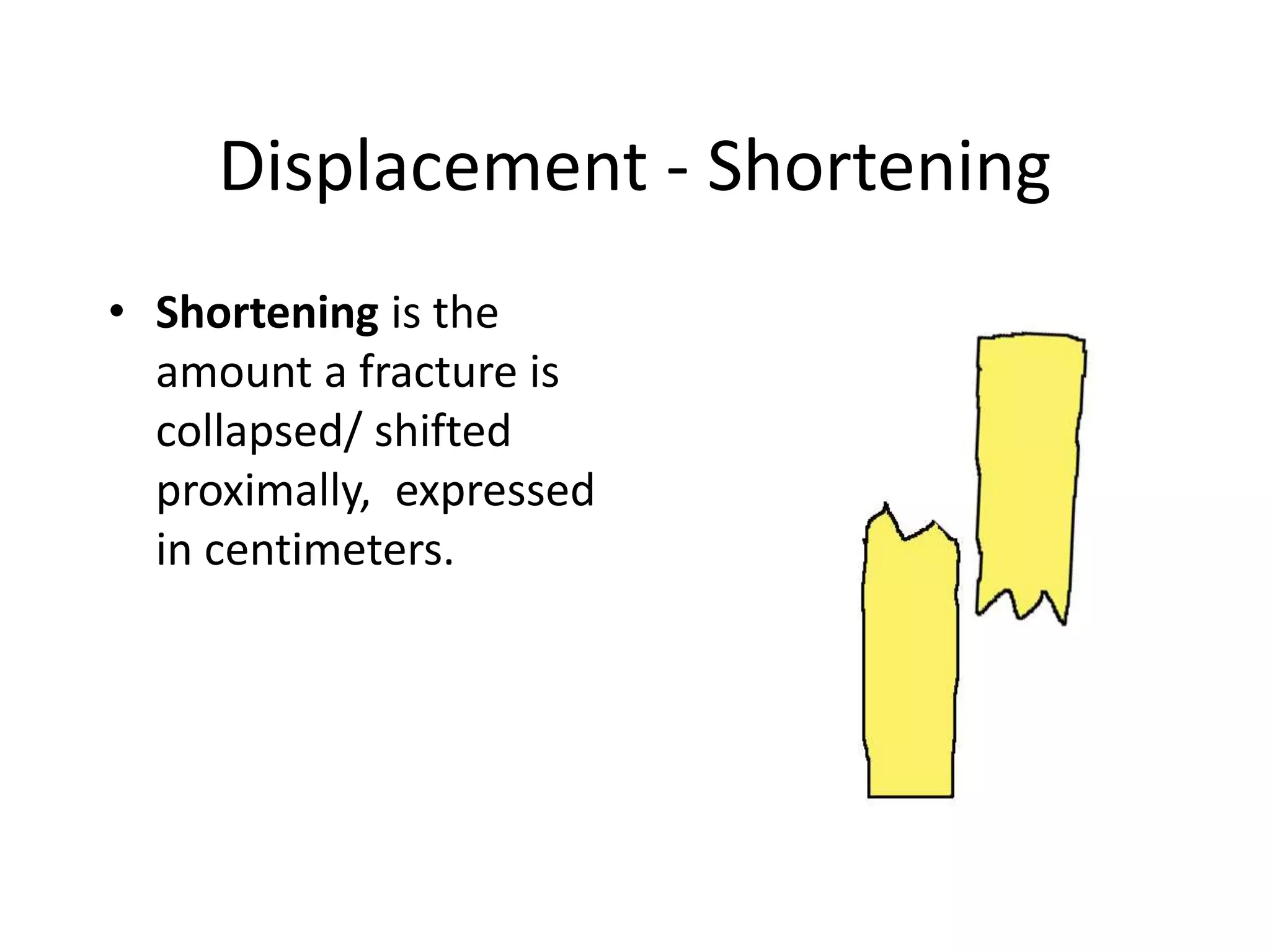 Displacement - Shortening 
• Shortening is the 
amount a fracture is 
collapsed/ shifted 
proximally, expressed 
in centimeters. 
 