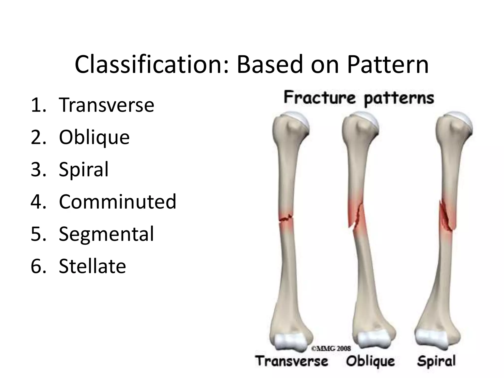 Classification: Based on Pattern 
1. Transverse 
2. Oblique 
3. Spiral 
4. Comminuted 
5. Segmental 
6. Stellate 
 