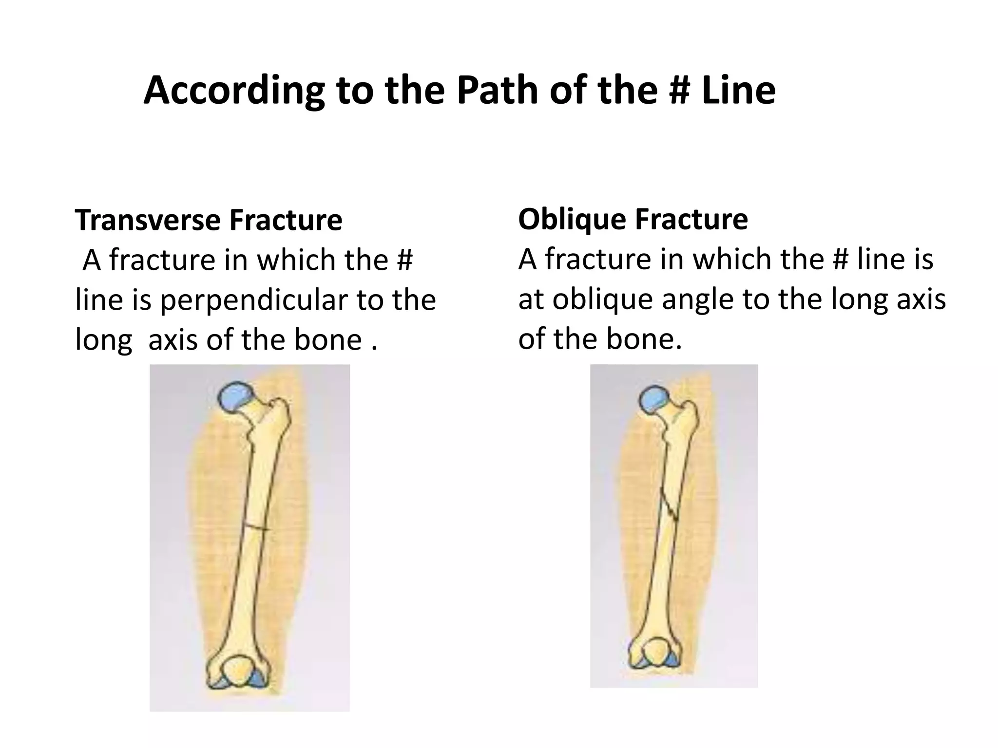 According to the Path of the # Line 
Transverse Fracture 
A fracture in which the # 
line is perpendicular to the 
long axis of the bone . 
Oblique Fracture 
A fracture in which the # line is 
at oblique angle to the long axis 
of the bone. 
 
