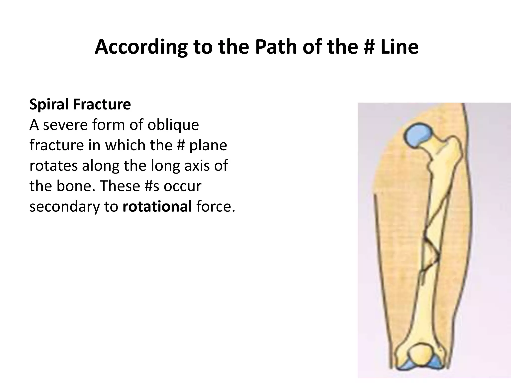 According to the Path of the # Line 
Spiral Fracture 
A severe form of oblique 
fracture in which the # plane 
rotates along the long axis of 
the bone. These #s occur 
secondary to rotational force. 
 