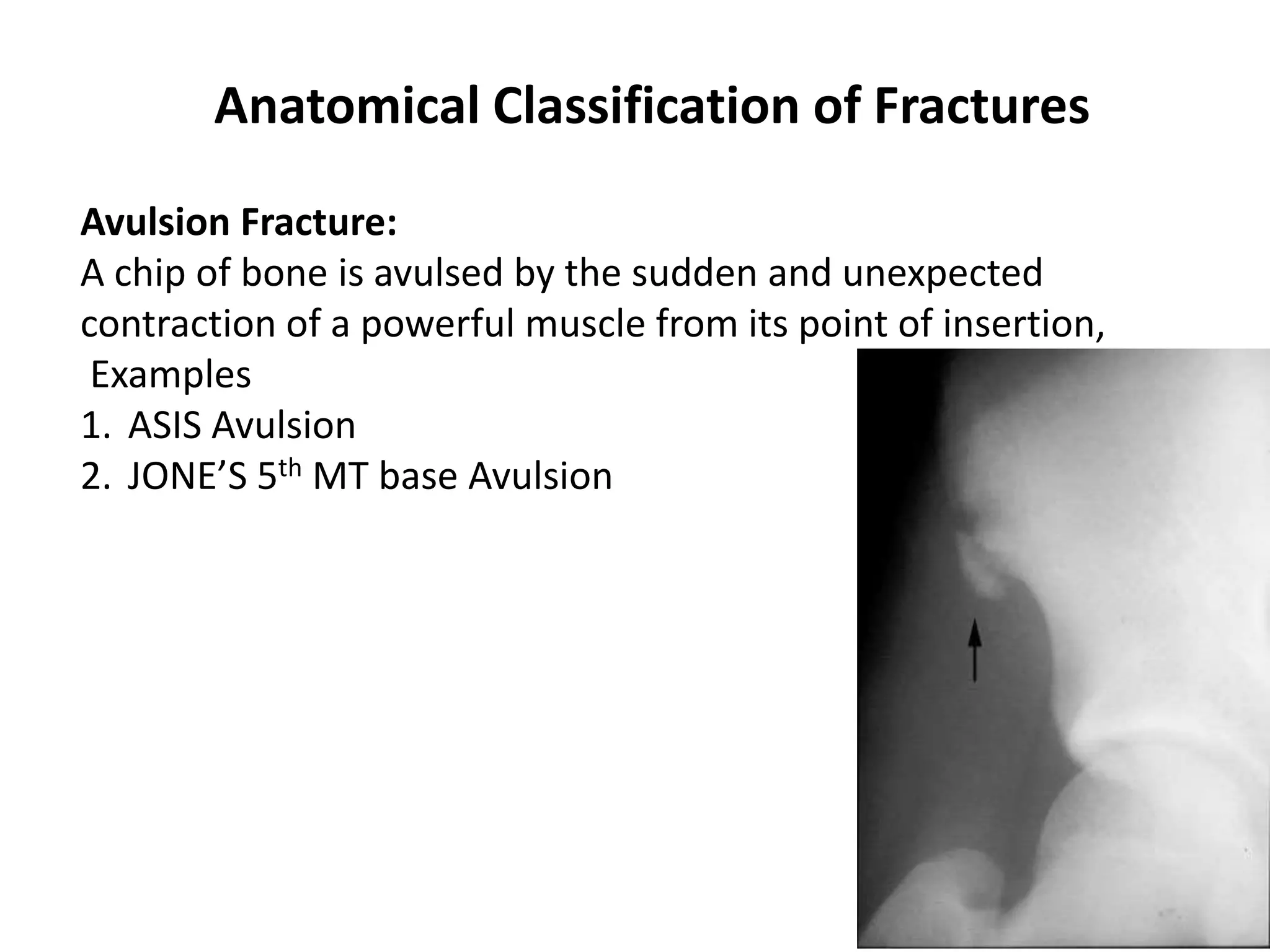 Anatomical Classification of Fractures 
Avulsion Fracture: 
A chip of bone is avulsed by the sudden and unexpected 
contraction of a powerful muscle from its point of insertion, 
Examples 
1. ASIS Avulsion 
2. JONE’S 5th MT base Avulsion 
 