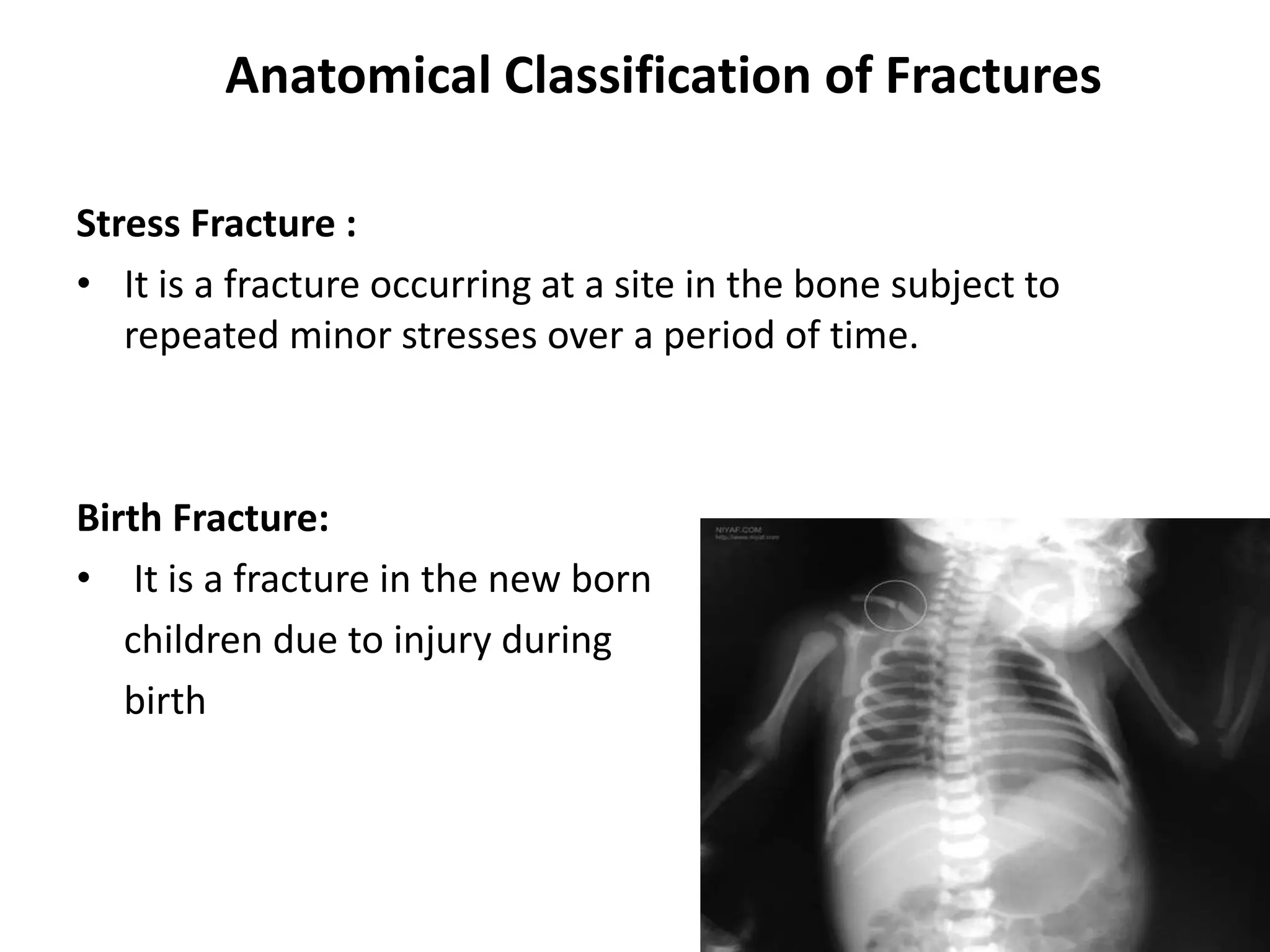 Anatomical Classification of Fractures 
Stress Fracture : 
• It is a fracture occurring at a site in the bone subject to 
repeated minor stresses over a period of time. 
Birth Fracture: 
• It is a fracture in the new born 
children due to injury during 
birth 
 