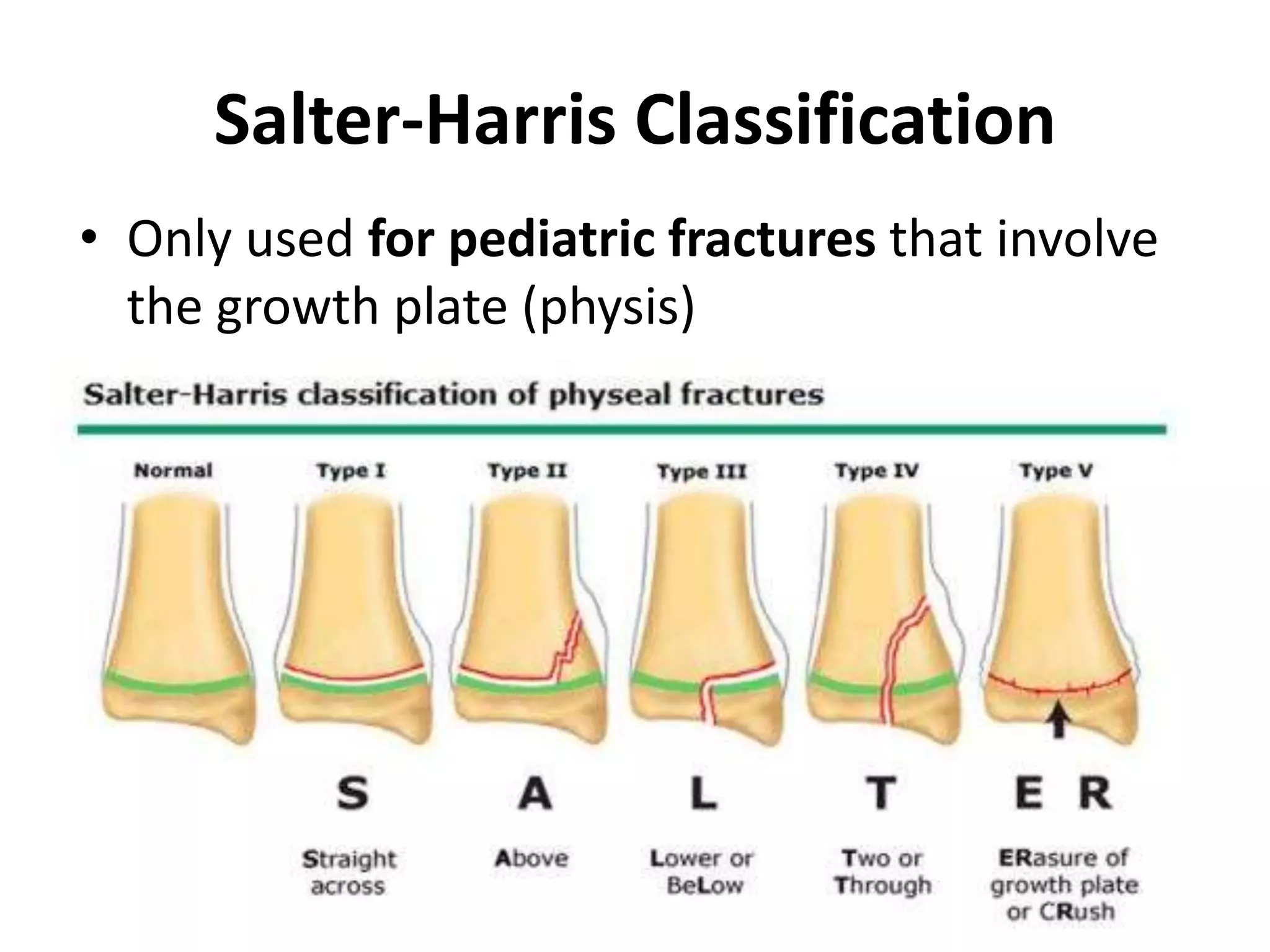 Salter-Harris Classification 
• Only used for pediatric fractures that involve 
the growth plate (physis) 
 