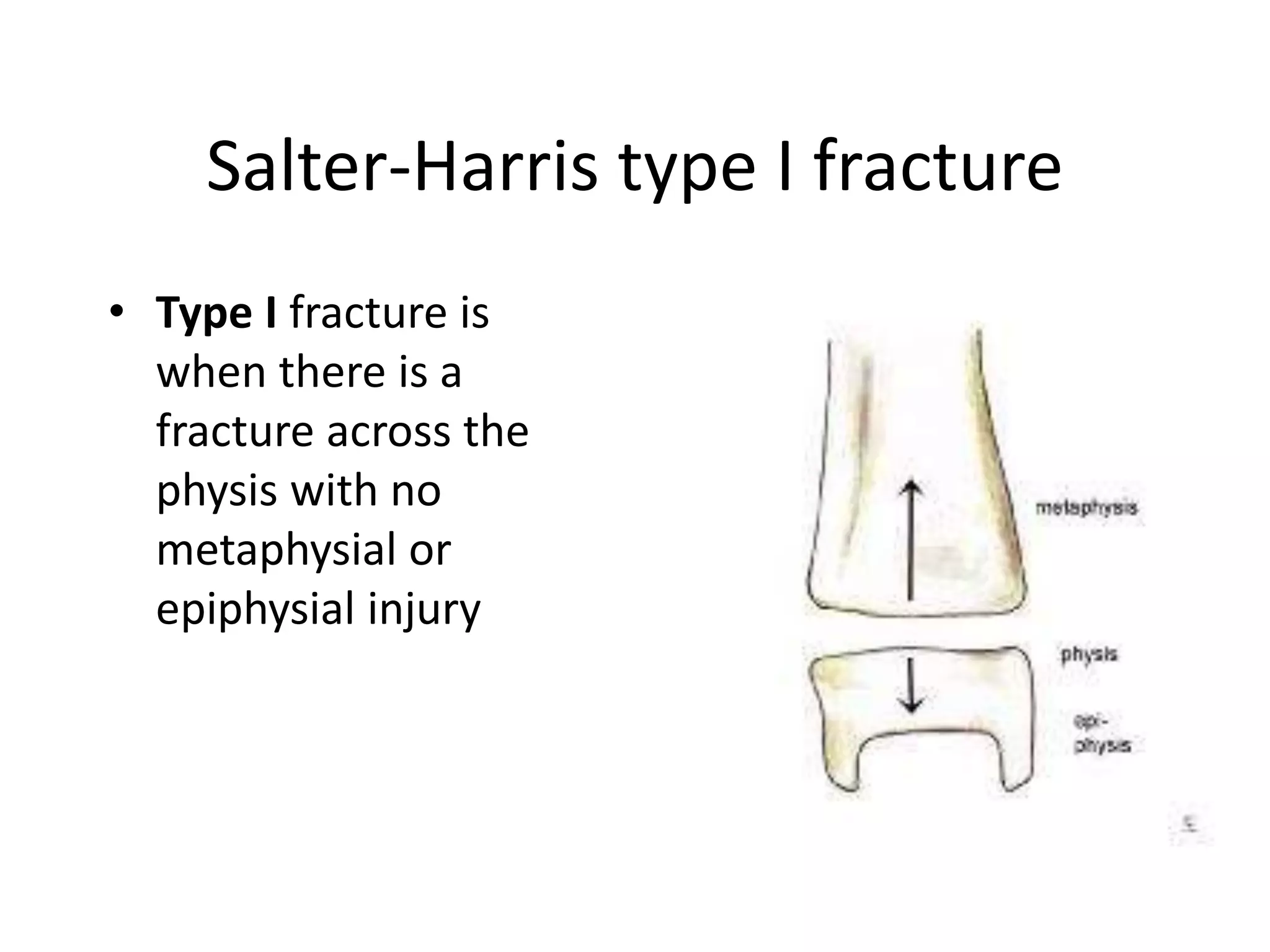 Salter-Harris type I fracture 
• Type I fracture is 
when there is a 
fracture across the 
physis with no 
metaphysial or 
epiphysial injury 
 