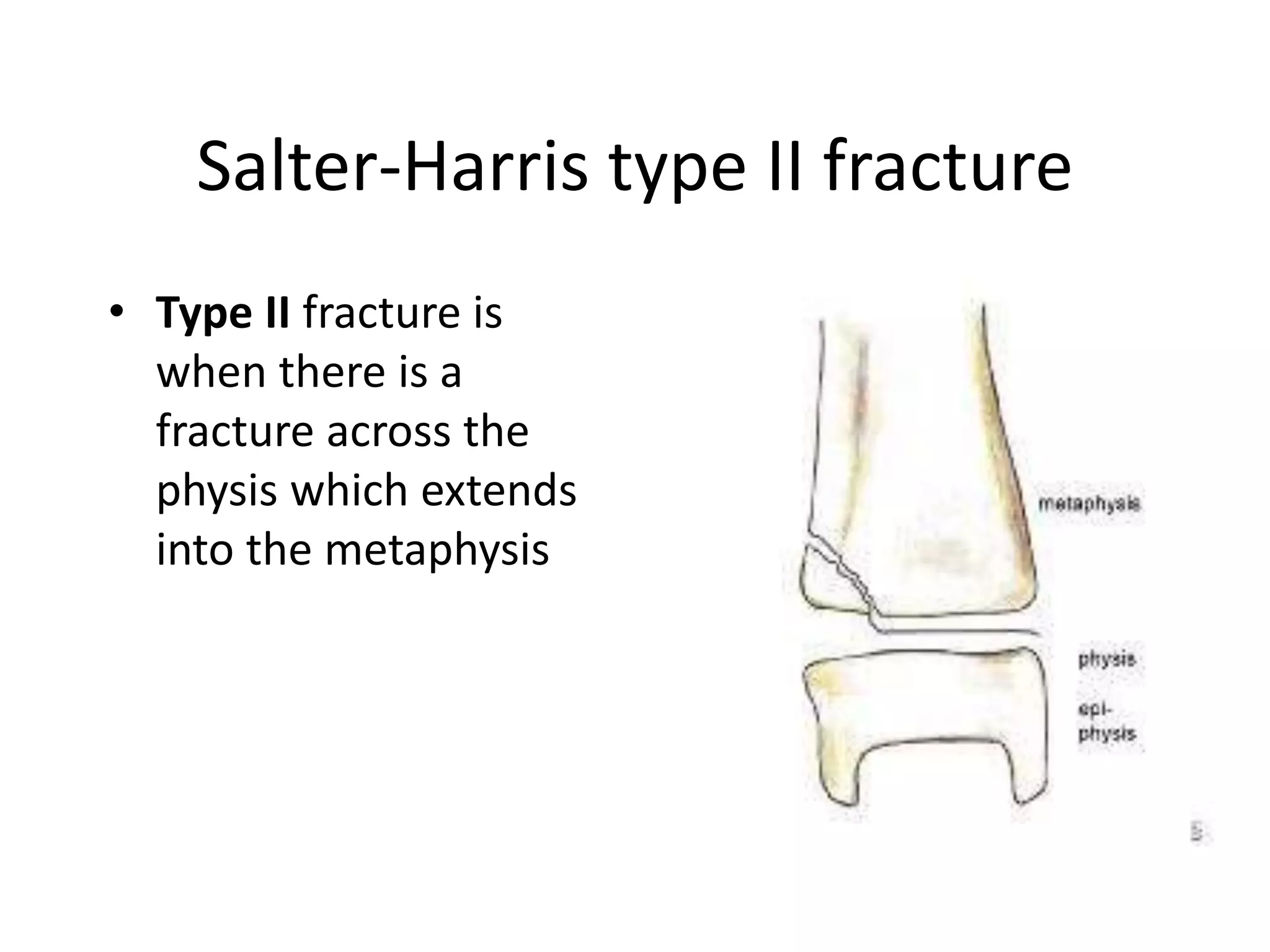 Salter-Harris type II fracture 
• Type II fracture is 
when there is a 
fracture across the 
physis which extends 
into the metaphysis 
 