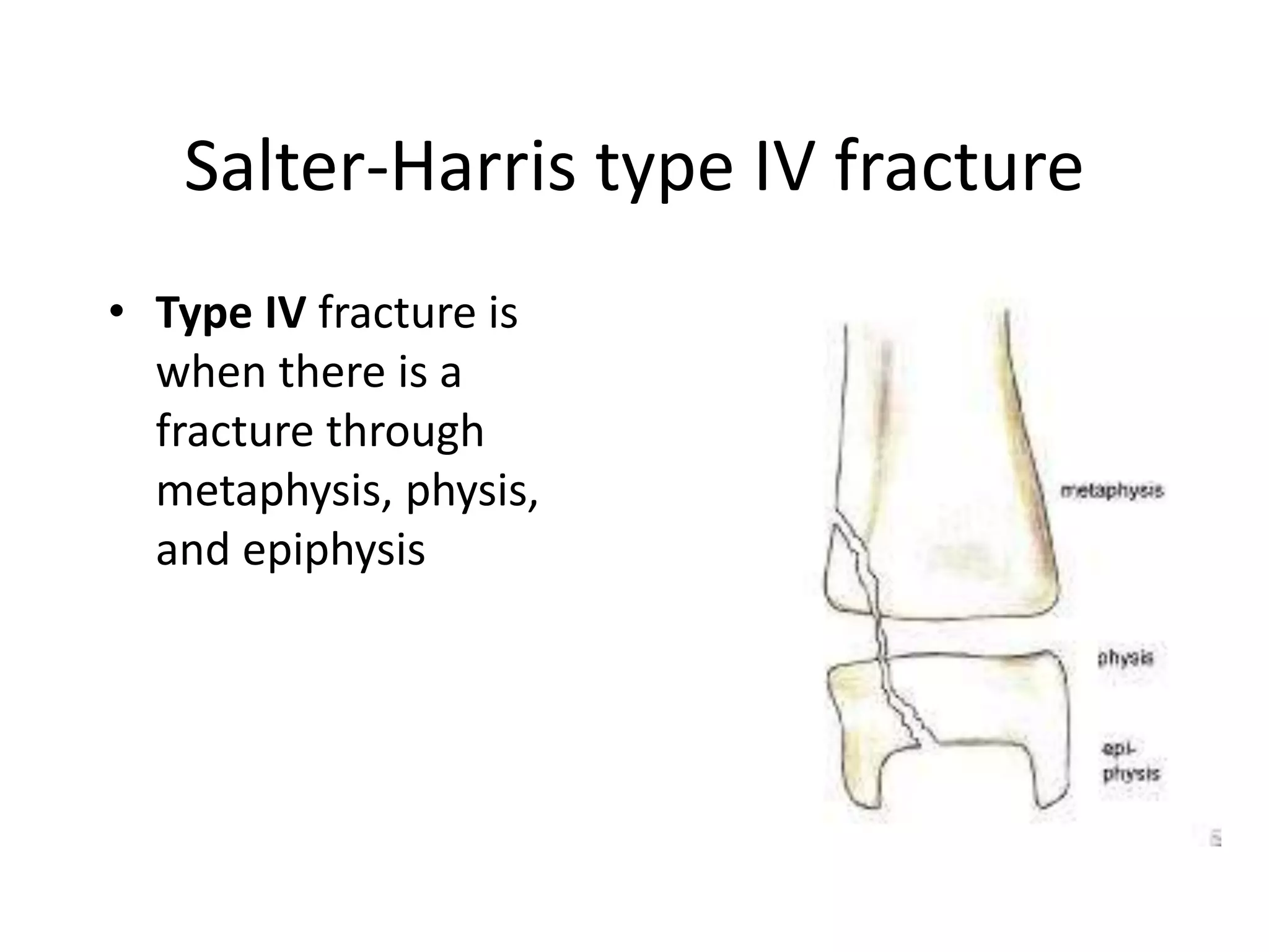 Salter-Harris type IV fracture 
• Type IV fracture is 
when there is a 
fracture through 
metaphysis, physis, 
and epiphysis 
 