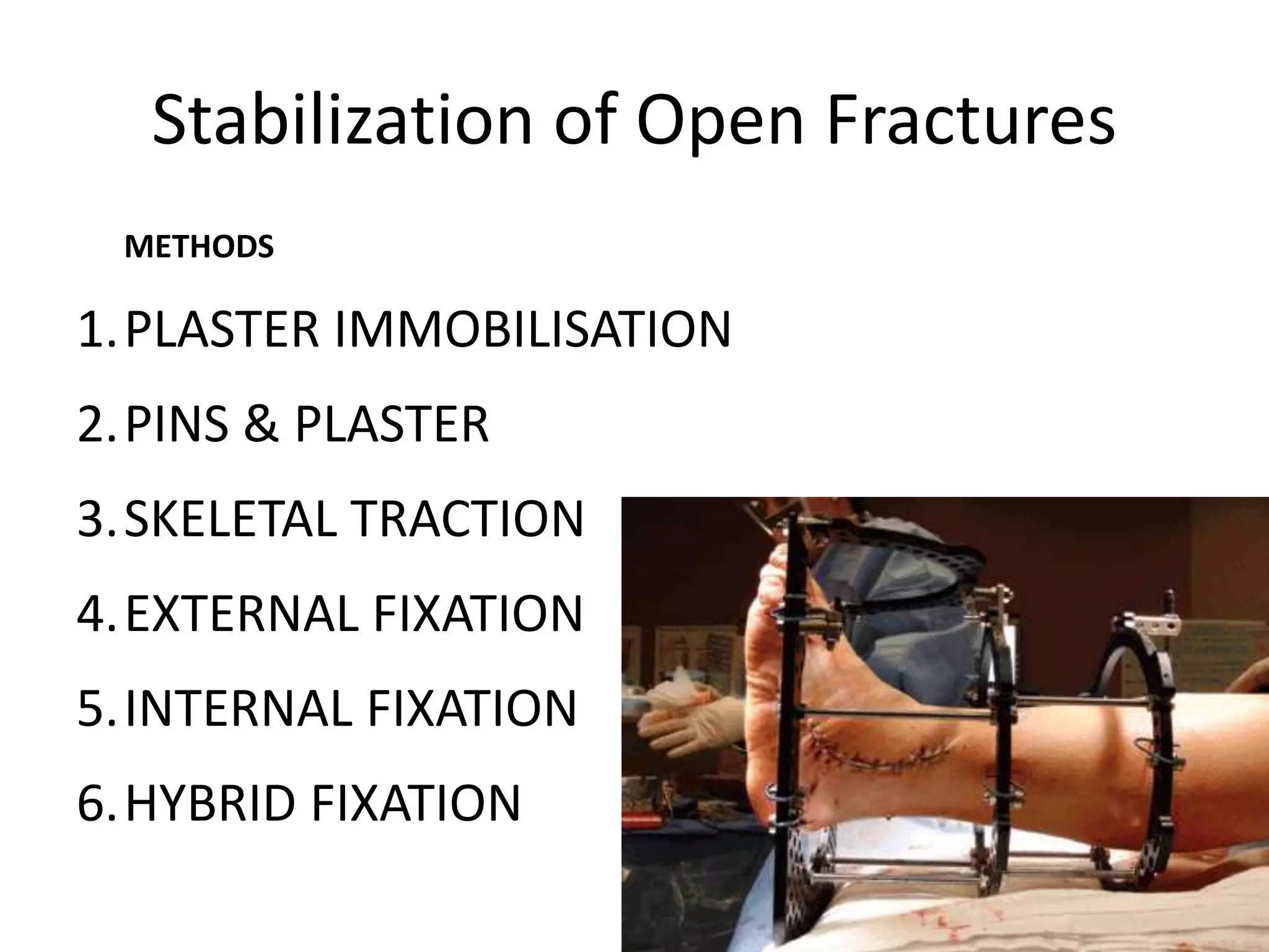 Stabilization of Open Fractures 
METHODS 
1.PLASTER IMMOBILISATION 
2.PINS & PLASTER 
3.SKELETAL TRACTION 
4.EXTERNAL FIXATION 
5.INTERNAL FIXATION 
6.HYBRID FIXATION 
 