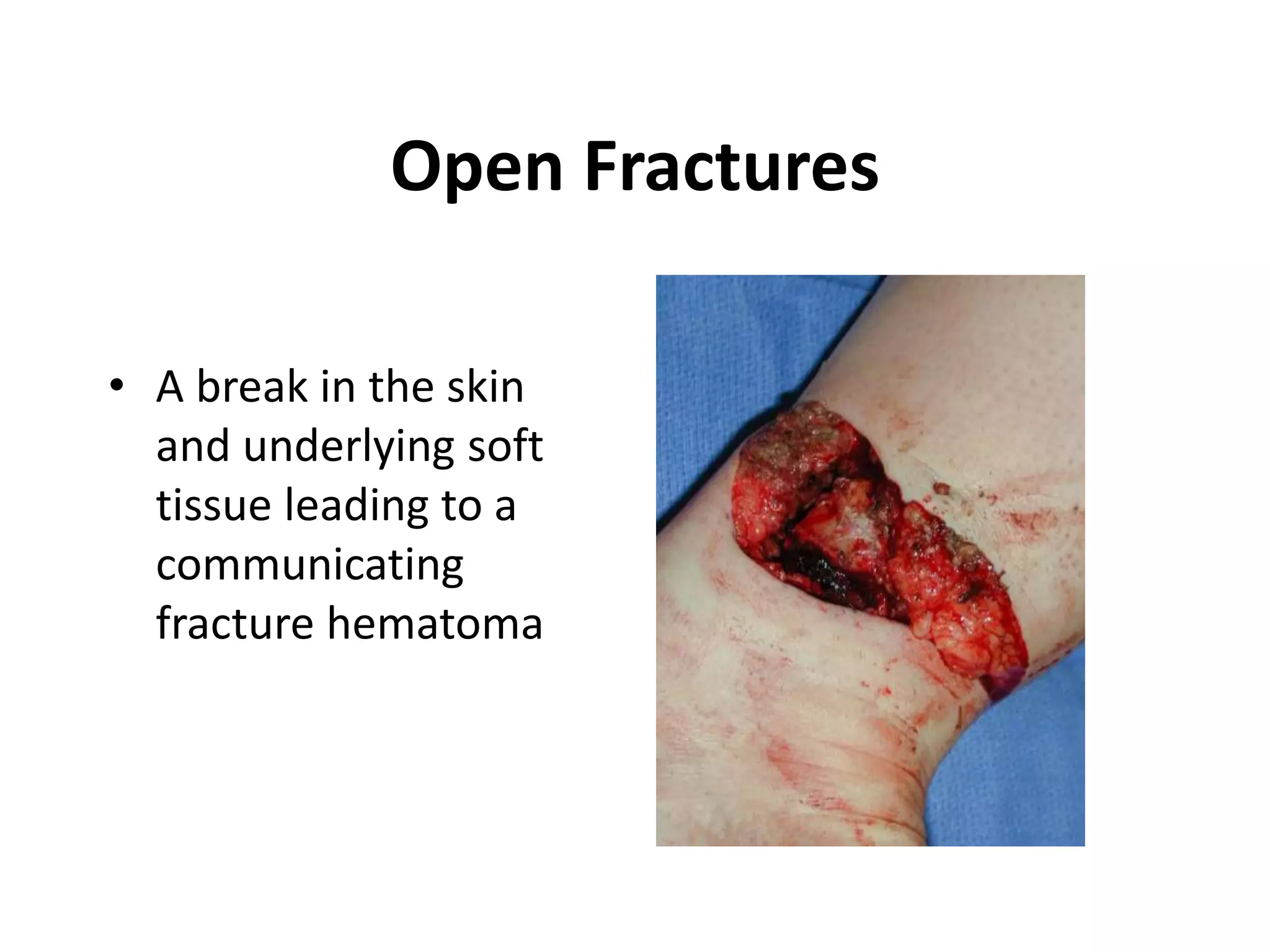 Open Fractures 
• A break in the skin 
and underlying soft 
tissue leading to a 
communicating 
fracture hematoma 
 