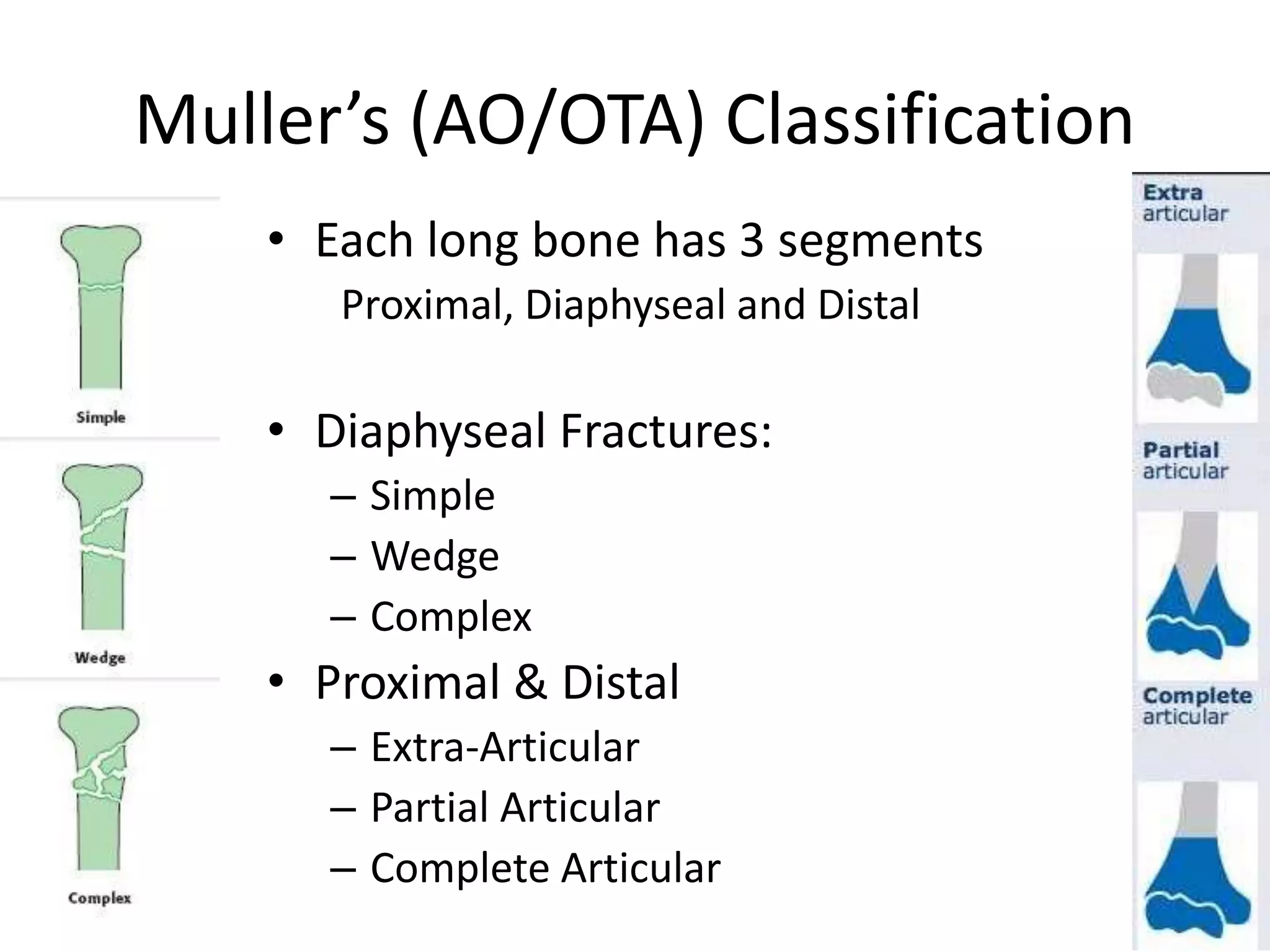Muller’s (AO/OTA) Classification 
• Each long bone has 3 segments 
Proximal, Diaphyseal and Distal 
• Diaphyseal Fractures: 
– Simple 
– Wedge 
– Complex 
• Proximal & Distal 
– Extra-Articular 
– Partial Articular 
– Complete Articular 
 