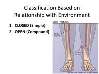 Classification Of Fractures Compound Fracture Managment