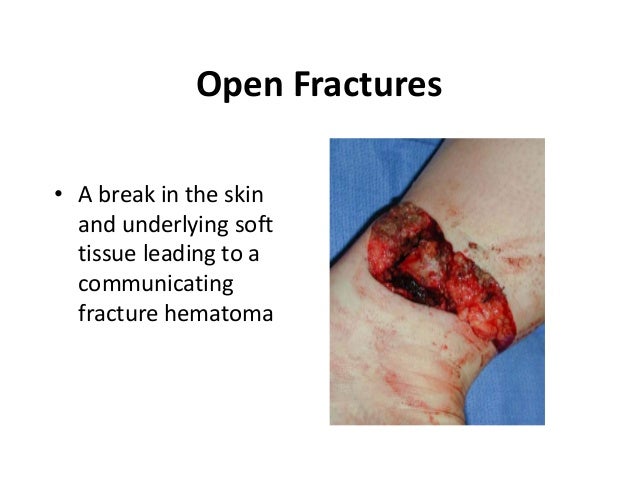 Classification Of Fractures Compound Fracture Managment