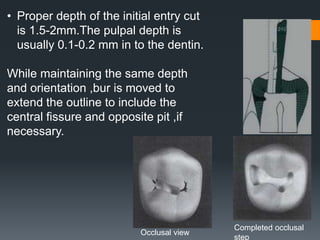 10
• Proper depth of the initial entry cut
is 1.5-2mm.The pulpal depth is
usually 0.1-0.2 mm in to the dentin.
While maintaining the same depth
and orientation ,bur is moved to
extend the outline to include the
central fissure and opposite pit ,if
necessary.
Completed occlusal
step
Occlusal view
 