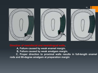 16
Direction of mesiofacial and mesiolingual walls.
A, Failure caused by weak enamel margin.
B, Failure caused by weak amalgam margin.
C, Proper direction to proximal walls results in full-length enamel
rods and 90-degree amalgam at preparation margin
 