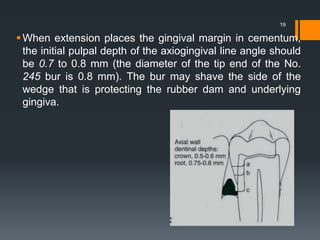 When extension places the gingival margin in cementum,
the initial pulpal depth of the axiogingival line angle should
be 0.7 to 0.8 mm (the diameter of the tip end of the No.
245 bur is 0.8 mm). The bur may shave the side of the
wedge that is protecting the rubber dam and underlying
gingiva.
19
 