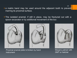 a matrix band may be used around the adjacent tooth to prevent
marring its proximal surface.
 The isolated enamel, if still in place, may be fractured out with a
spoon excavator or by additional movement of the bur.
25
Proximal enamel plate is broken by hand
instrument
Margins palned with
GMT or hatchet
 