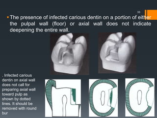 The presence of infected carious dentin on a portion of either
the pulpal wall (floor) or axial wall does not indicate
deepening the entire wall.
33
. Infected carious
dentin on axial wall
does not call for
preparing axial wall
toward pulp as
shown by dotted
lines. It should be
removed with round
bur
 