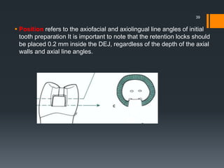  Position refers to the axiofacial and axiolingual line angles of initial
tooth preparation It is important to note that the retention locks should
be placed 0.2 mm inside the DEJ, regardless of the depth of the axial
walls and axial line angles.
39
 