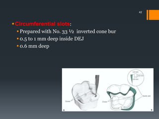 Circumferential slots:
 Prepared with No. 33 ½ inverted cone bur
 0.5 to 1 mm deep inside DEJ
 0.6 mm deep
42
 