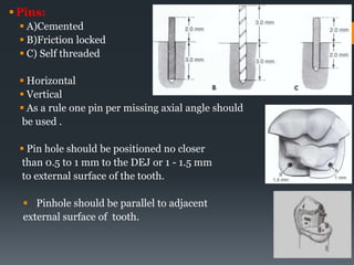  Pins:
 A)Cemented
 B)Friction locked
 C) Self threaded
 Horizontal
 Vertical
 As a rule one pin per missing axial angle should
be used .
 Pin hole should be positioned no closer
than 0.5 to 1 mm to the DEJ or 1 - 1.5 mm
to external surface of the tooth.
 Pinhole should be parallel to adjacent
external surface of tooth.
43
 