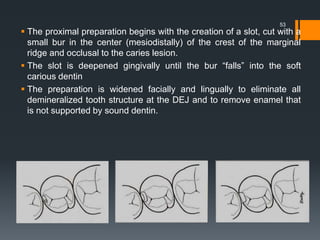  The proximal preparation begins with the creation of a slot, cut with a
small bur in the center (mesiodistally) of the crest of the marginal
ridge and occlusal to the caries lesion.
 The slot is deepened gingivally until the bur “falls” into the soft
carious dentin
 The preparation is widened facially and lingually to eliminate all
demineralized tooth structure at the DEJ and to remove enamel that
is not supported by sound dentin.
53
 