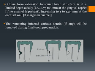  Outline form extension to sound tooth structure is at a
limited depth axially (i.e., 0.75 to 1 mm at the gingival aspect
[if no enamel is present], increasing to 1 to 1.25 mm at the
occlusal wall [if margin in enamel]
 The remaining infected carious dentin (if any) will be
removed during final tooth preparation.
55
 