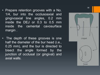 56
• Prepare retention grooves with a No.
1/4, bur into the occlusoaxial and
gingivoaxial line angles, 0.2 mm
inside the DEJ or 0.3 to 0.5 mm
inside the cemental cavosurface
margin .
• The depth of these grooves is one
half the diameter of the bur head (i.e.,
0.25 mm), and the bur is directed to
bisect the angle formed by the
junction of occlusal (or gingival) and
axial walls.
 