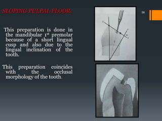 58SLOPING PULPAL FLOOR.
This preparation is done in
the mandibular 1st premolar
because of a short lingual
cusp and also due to the
lingual inclination of the
tooth.
This preparation coincides
with the occlusal
morphology of the tooth.
 