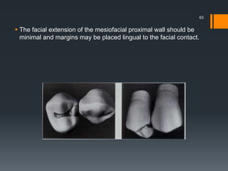  The facial extension of the mesiofacial proximal wall should be
minimal and margins may be placed lingual to the facial contact.
63
 