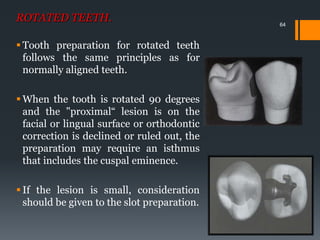 64
ROTATED TEETH.
 Tooth preparation for rotated teeth
follows the same principles as for
normally aligned teeth.
 When the tooth is rotated 90 degrees
and the "proximal“ lesion is on the
facial or lingual surface or orthodontic
correction is declined or ruled out, the
preparation may require an isthmus
that includes the cuspal eminence.
 If the lesion is small, consideration
should be given to the slot preparation.
 