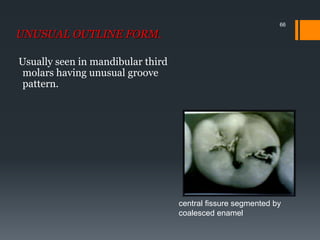 66
UNUSUAL OUTLINE FORM.
Usually seen in mandibular third
molars having unusual groove
pattern.
central fissure segmented by
coalesced enamel
 