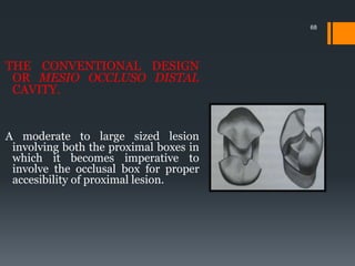68
THE CONVENTIONAL DESIGN
OR MESIO OCCLUSO DISTAL
CAVITY.
A moderate to large sized lesion
involving both the proximal boxes in
which it becomes imperative to
involve the occlusal box for proper
accesibility of proximal lesion.
 