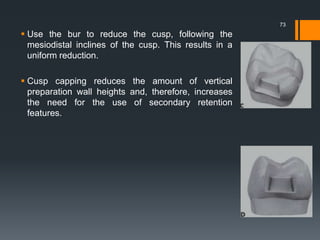  Use the bur to reduce the cusp, following the
mesiodistal inclines of the cusp. This results in a
uniform reduction.
 Cusp capping reduces the amount of vertical
preparation wall heights and, therefore, increases
the need for the use of secondary retention
features.
73
 