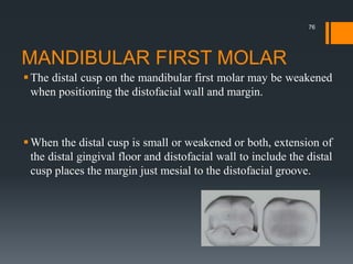 MANDIBULAR FIRST MOLAR
The distal cusp on the mandibular first molar may be weakened
when positioning the distofacial wall and margin.
When the distal cusp is small or weakened or both, extension of
the distal gingival floor and distofacial wall to include the distal
cusp places the margin just mesial to the distofacial groove.
76
 
