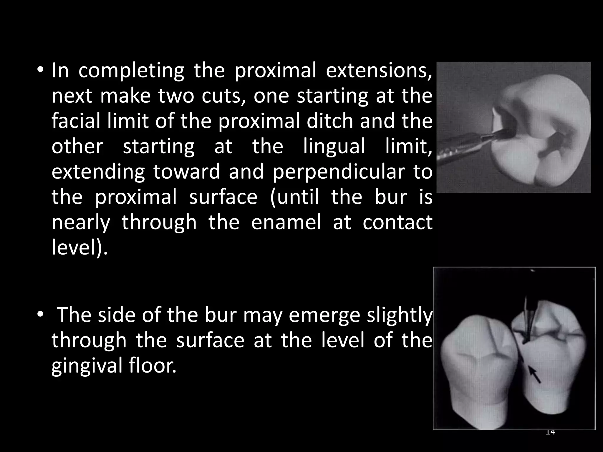 • In completing the proximal extensions,
next make two cuts, one starting at the
facial limit of the proximal ditch and the
other starting at the lingual limit,
extending toward and perpendicular to
the proximal surface (until the bur is
nearly through the enamel at contact
level).
• The side of the bur may emerge slightly
through the surface at the level of the
gingival floor.
14
 
