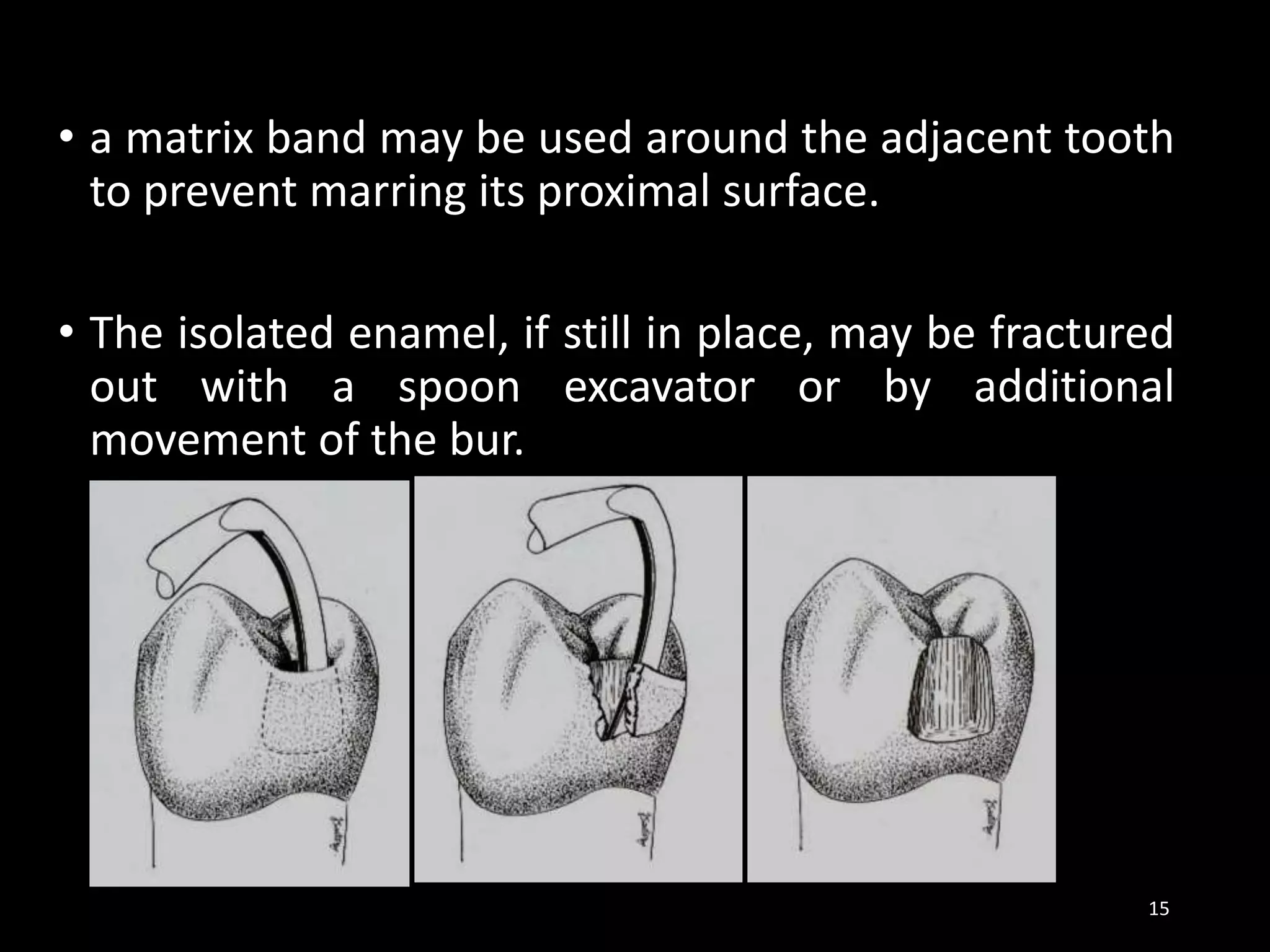 • a matrix band may be used around the adjacent tooth
to prevent marring its proximal surface.
• The isolated enamel, if still in place, may be fractured
out with a spoon excavator or by additional
movement of the bur.
15
 
