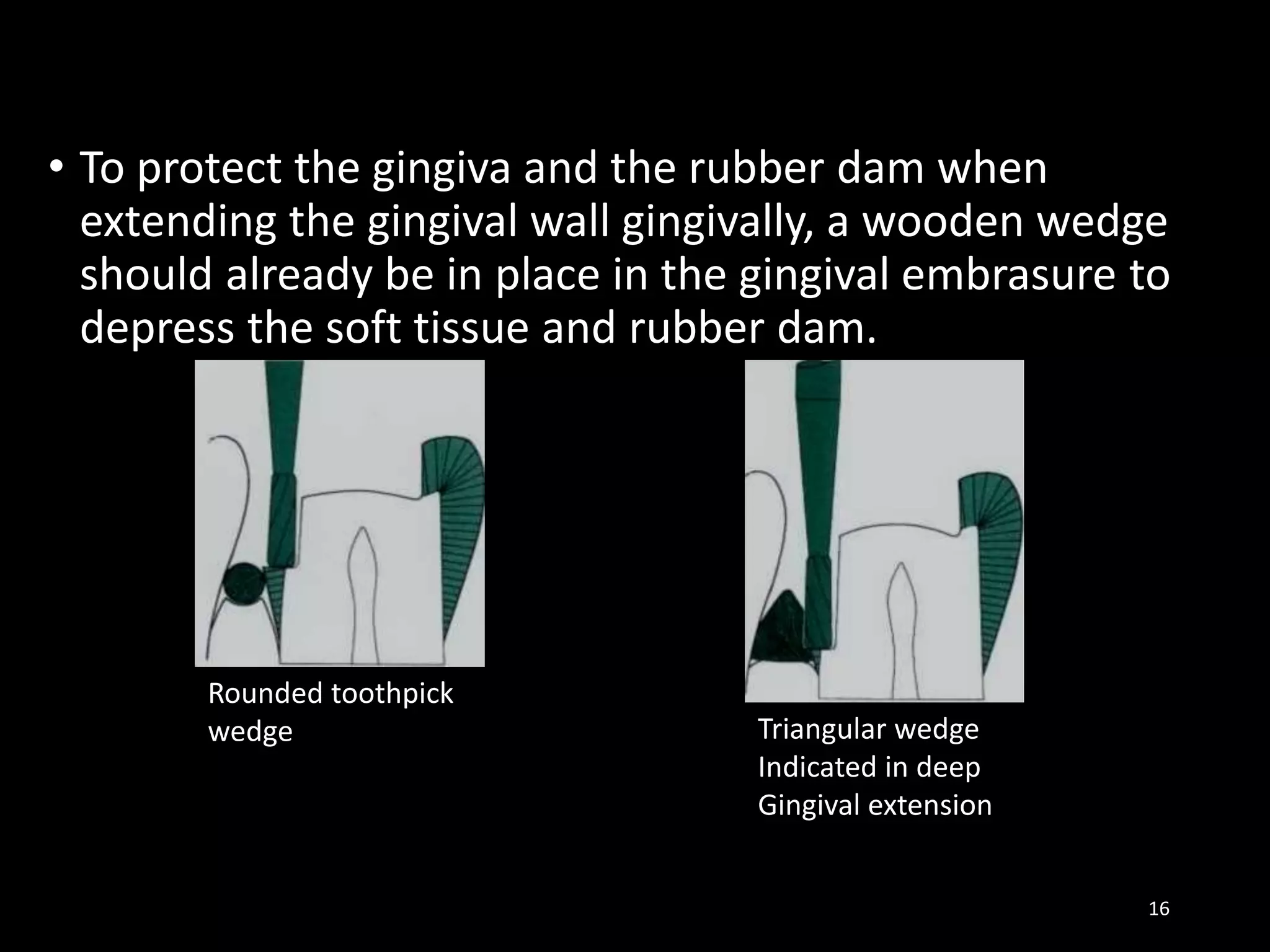 • To protect the gingiva and the rubber dam when
extending the gingival wall gingivally, a wooden wedge
should already be in place in the gingival embrasure to
depress the soft tissue and rubber dam.
16
Rounded toothpick
wedge Triangular wedge
Indicated in deep
Gingival extension
 