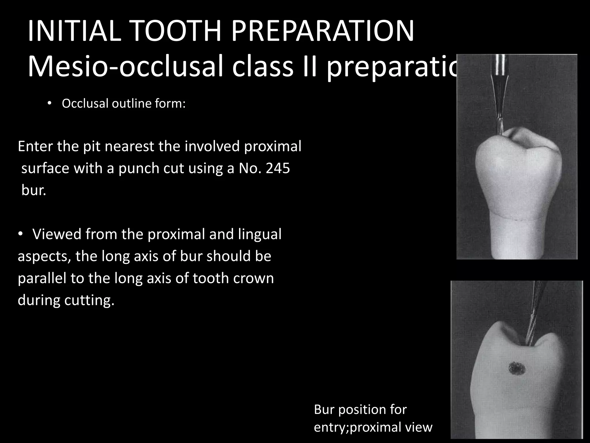 INITIAL TOOTH PREPARATION
Mesio-occlusal class II preparation
• Occlusal outline form:
Enter the pit nearest the involved proximal
surface with a punch cut using a No. 245
bur.
• Viewed from the proximal and lingual
aspects, the long axis of bur should be
parallel to the long axis of tooth crown
during cutting.
2
Bur position for
entry;proximal view
 