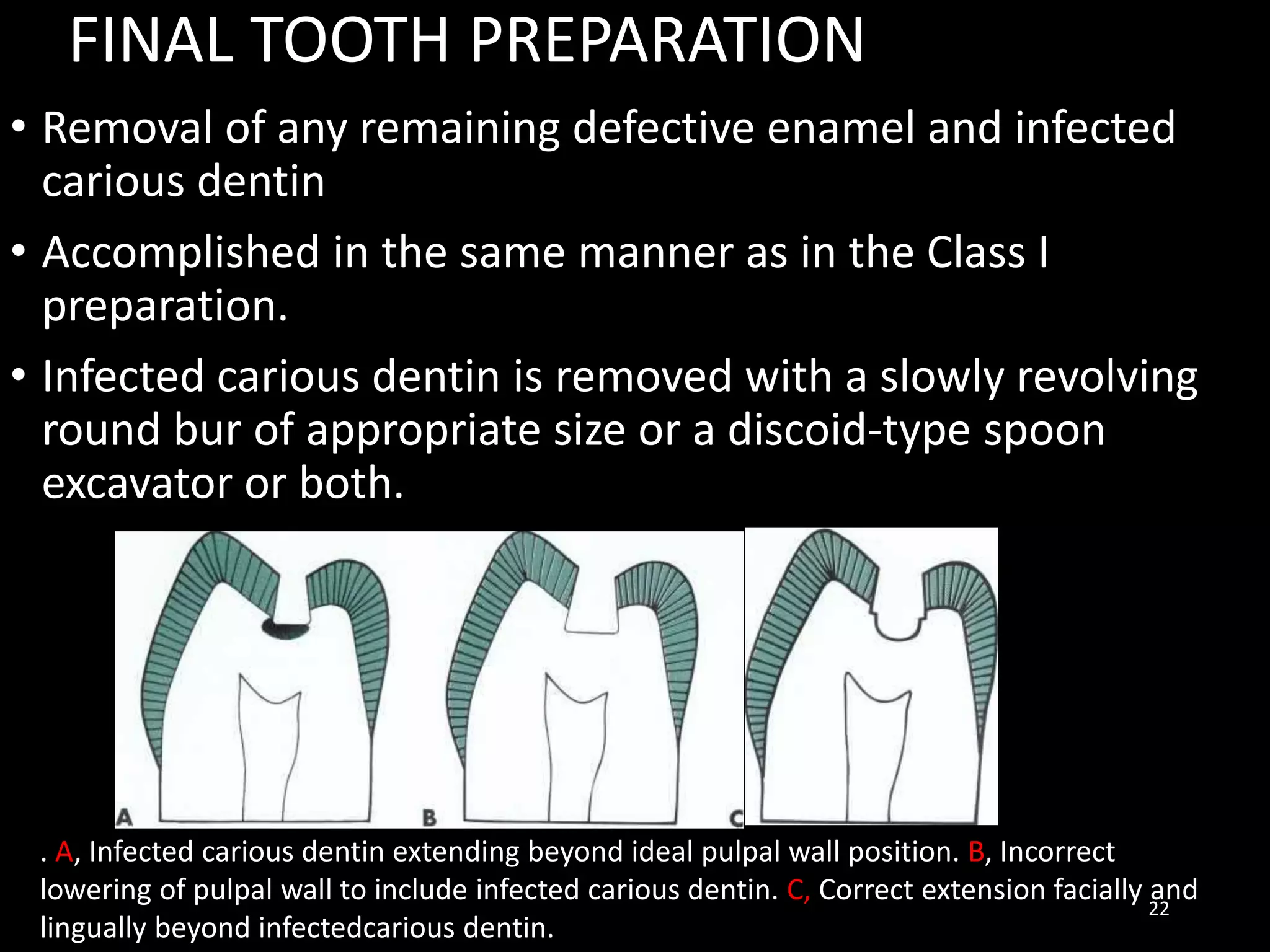 FINAL TOOTH PREPARATION
• Removal of any remaining defective enamel and infected
carious dentin
• Accomplished in the same manner as in the Class I
preparation.
• Infected carious dentin is removed with a slowly revolving
round bur of appropriate size or a discoid-type spoon
excavator or both.
22
. A, Infected carious dentin extending beyond ideal pulpal wall position. B, Incorrect
lowering of pulpal wall to include infected carious dentin. C, Correct extension facially and
lingually beyond infectedcarious dentin.
 