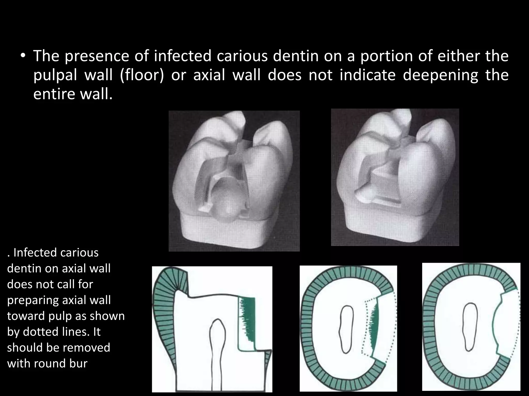 • The presence of infected carious dentin on a portion of either the
pulpal wall (floor) or axial wall does not indicate deepening the
entire wall.
23
. Infected carious
dentin on axial wall
does not call for
preparing axial wall
toward pulp as shown
by dotted lines. It
should be removed
with round bur
 