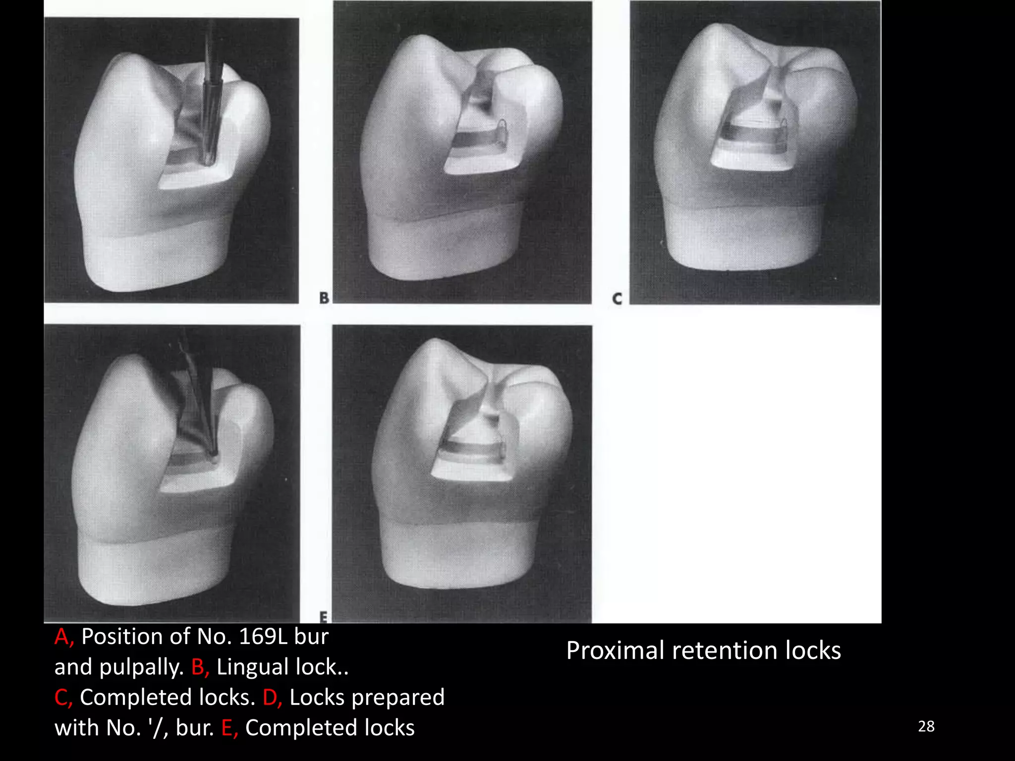 Proximal retention locks
28
A, Position of No. 169L bur
and pulpally. B, Lingual lock..
C, Completed locks. D, Locks prepared
with No. '/, bur. E, Completed locks
 