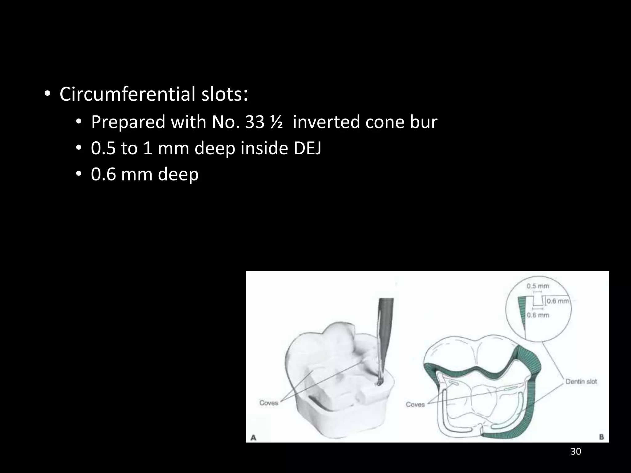 • Circumferential slots:
• Prepared with No. 33 ½ inverted cone bur
• 0.5 to 1 mm deep inside DEJ
• 0.6 mm deep
30
 