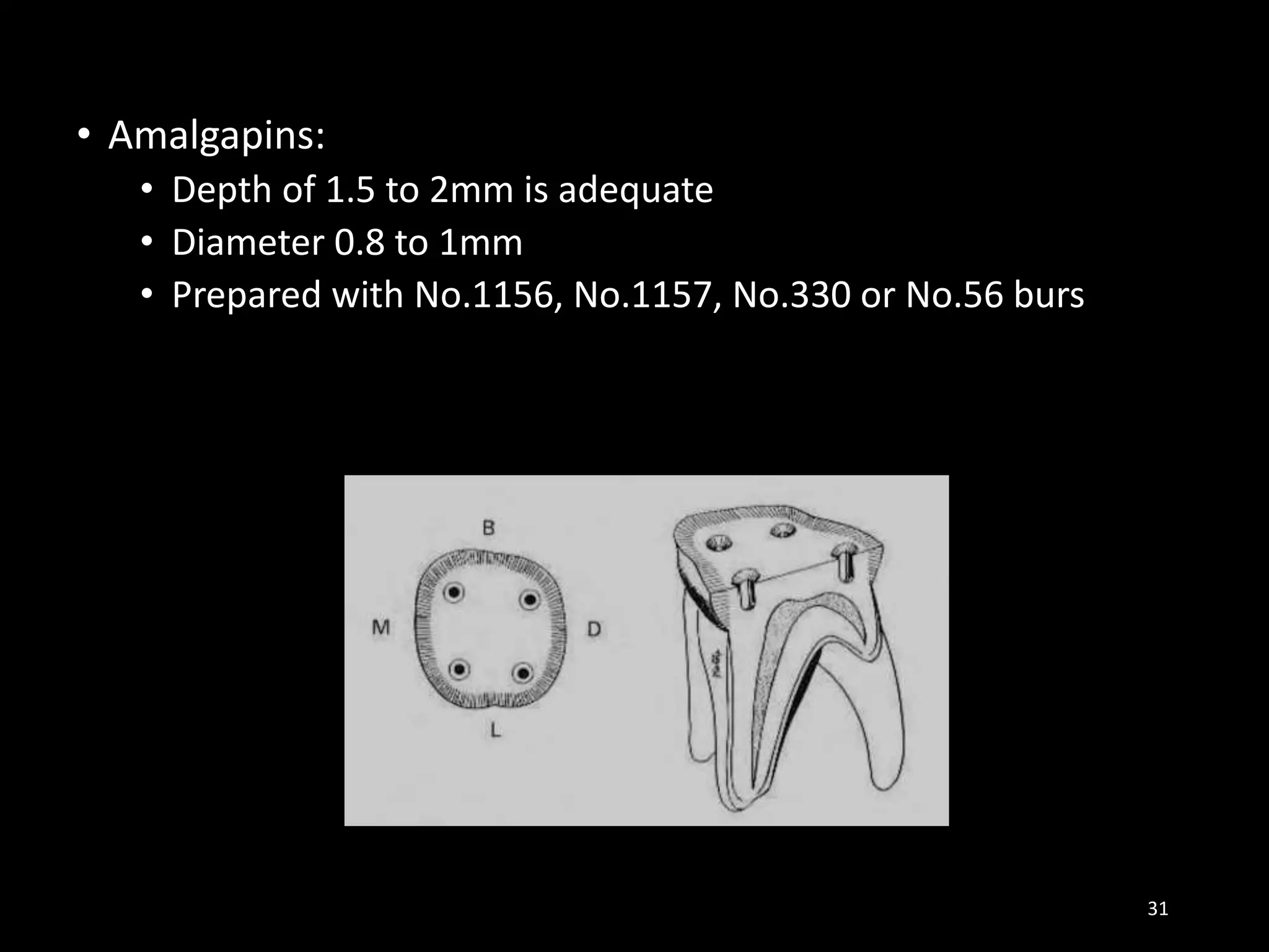 • Amalgapins:
• Depth of 1.5 to 2mm is adequate
• Diameter 0.8 to 1mm
• Prepared with No.1156, No.1157, No.330 or No.56 burs
31
 