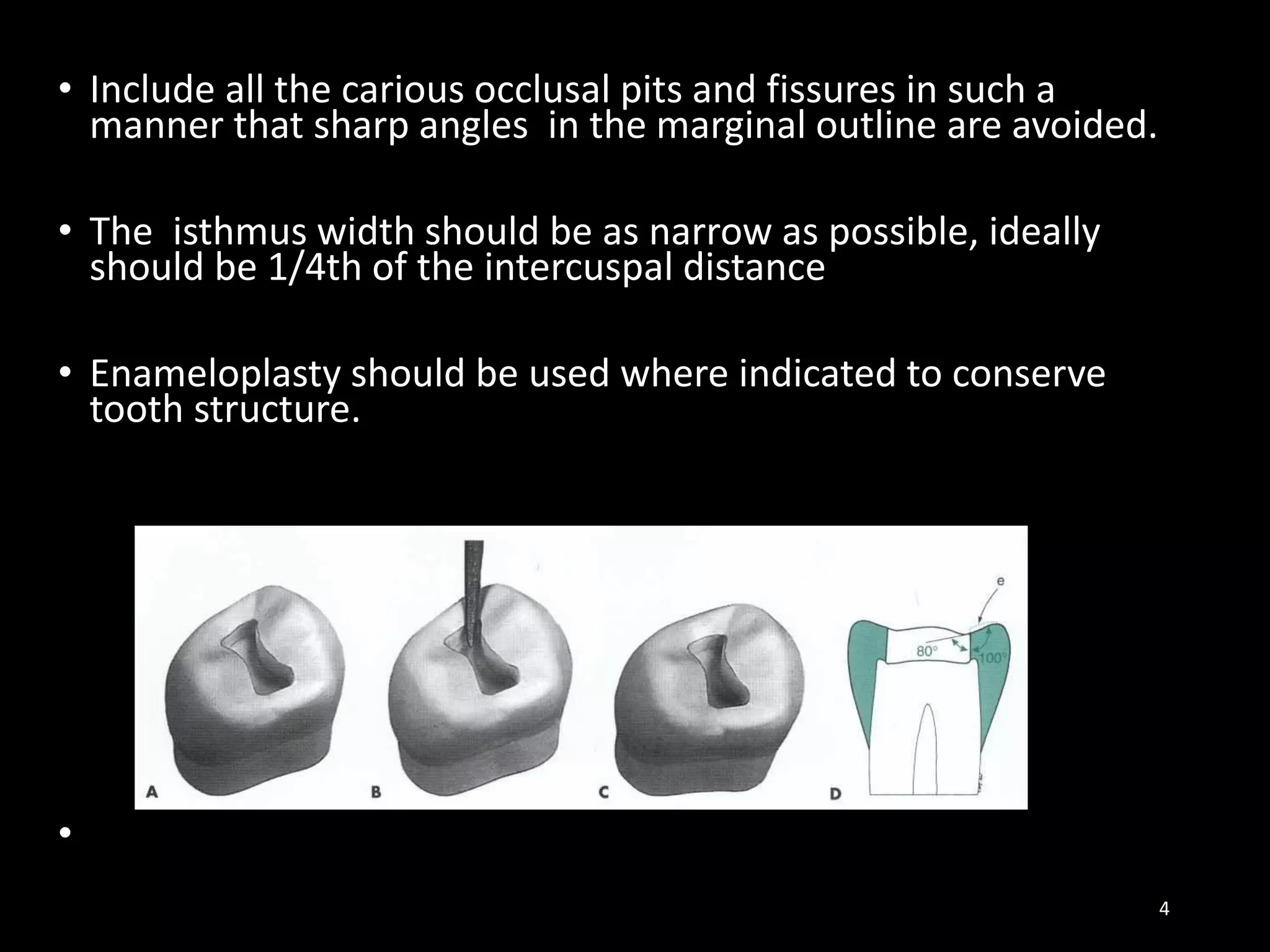 • Include all the carious occlusal pits and fissures in such a
manner that sharp angles in the marginal outline are avoided.
• The isthmus width should be as narrow as possible, ideally
should be 1/4th of the intercuspal distance
• Enameloplasty should be used where indicated to conserve
tooth structure.
•
4
 