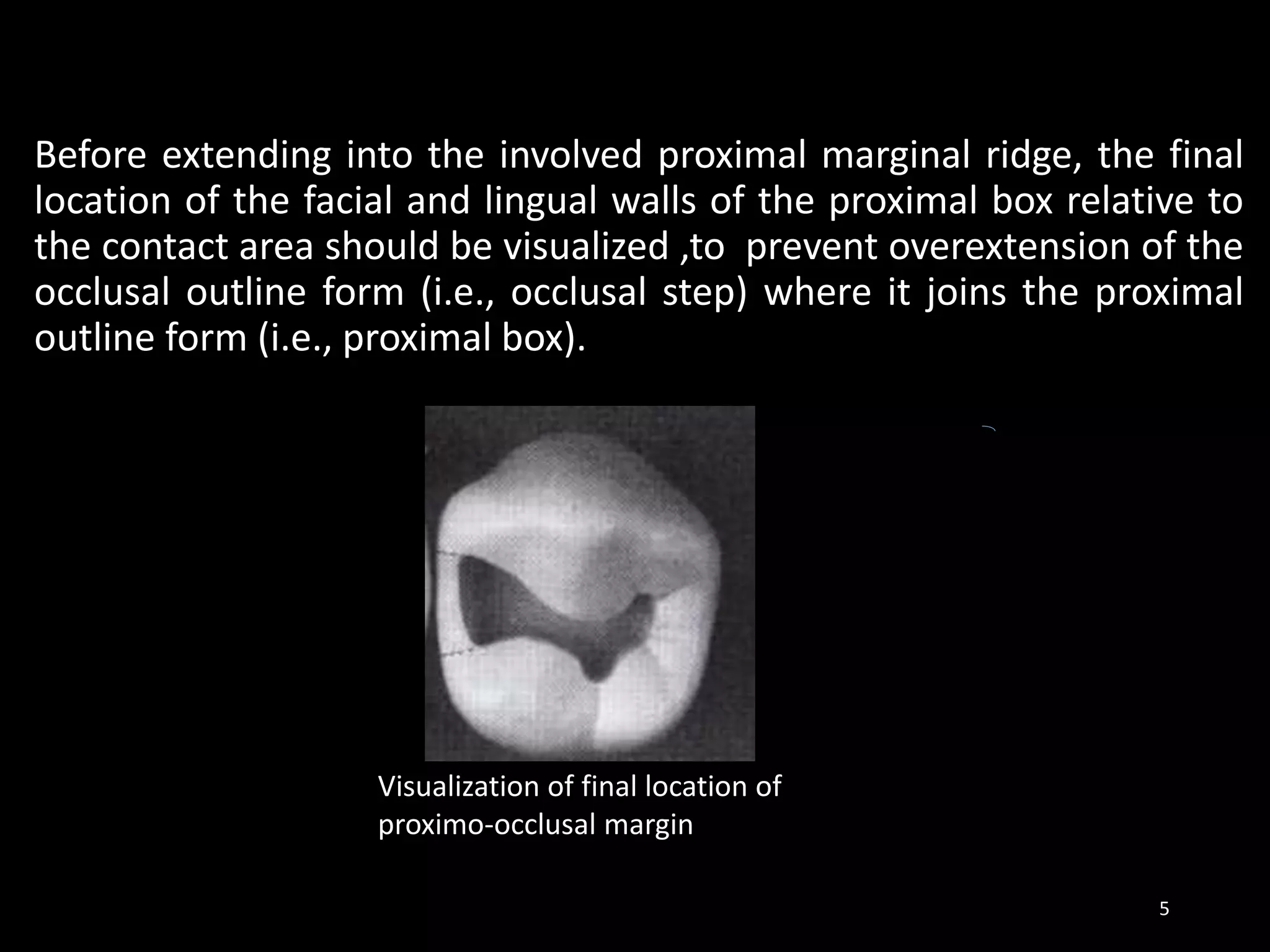 Before extending into the involved proximal marginal ridge, the final
location of the facial and lingual walls of the proximal box relative to
the contact area should be visualized ,to prevent overextension of the
occlusal outline form (i.e., occlusal step) where it joins the proximal
outline form (i.e., proximal box).
5
Visualization of final location of
proximo-occlusal margin
 