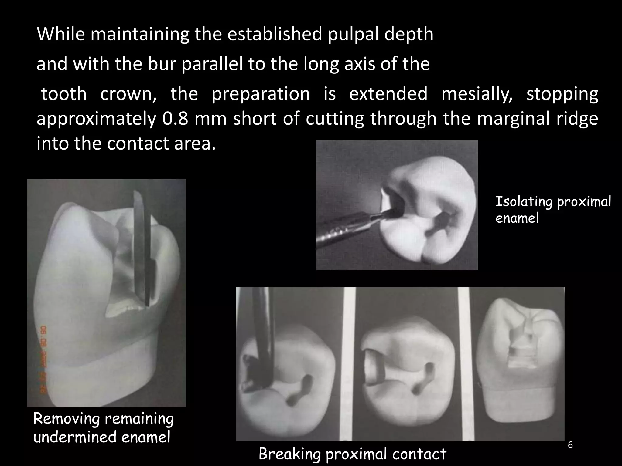 6
While maintaining the established pulpal depth
and with the bur parallel to the long axis of the
tooth crown, the preparation is extended mesially, stopping
approximately 0.8 mm short of cutting through the marginal ridge
into the contact area.
Removing remaining
undermined enamel
Breaking proximal contact
Isolating proximal
enamel
 