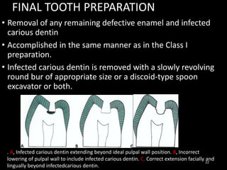 FINAL TOOTH PREPARATION
• Removal of any remaining defective enamel and infected
carious dentin
• Accomplished in the same manner as in the Class I
preparation.
• Infected carious dentin is removed with a slowly revolving
round bur of appropriate size or a discoid-type spoon
excavator or both.
22
. A, Infected carious dentin extending beyond ideal pulpal wall position. B, Incorrect
lowering of pulpal wall to include infected carious dentin. C, Correct extension facially and
lingually beyond infectedcarious dentin.
 