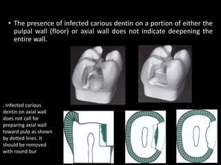 • The presence of infected carious dentin on a portion of either the
pulpal wall (floor) or axial wall does not indicate deepening the
entire wall.
23
. Infected carious
dentin on axial wall
does not call for
preparing axial wall
toward pulp as shown
by dotted lines. It
should be removed
with round bur
 