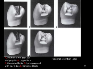 Proximal retention locks
28
A, Position of No. 169L bur
and pulpally. B, Lingual lock..
C, Completed locks. D, Locks prepared
with No. '/, bur. E, Completed locks
 